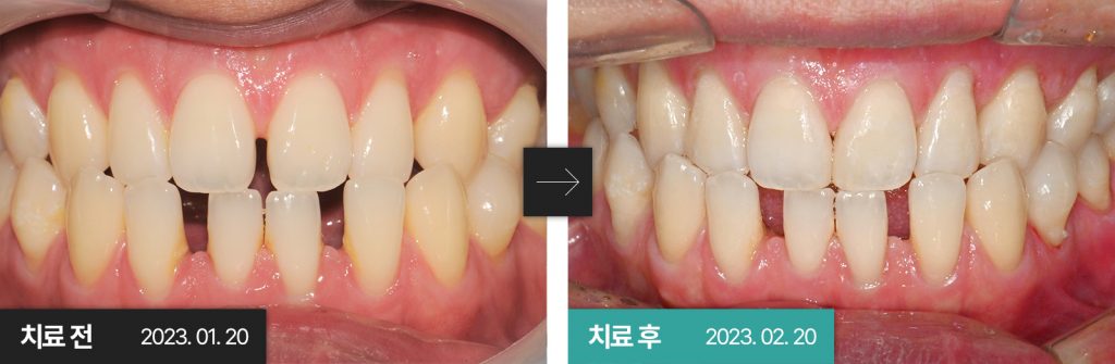 전치부 레진치료 — 연세미소미함치과