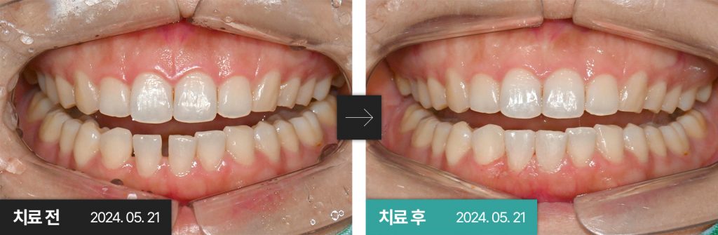 전치부 레진치료 — 연세미소미함치과